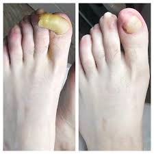Claw-like nail case study